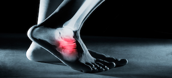 Image - Reflex Sympathetic