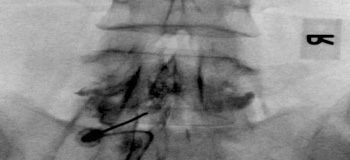 Image - Epidural Steroid injections