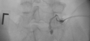 Facet Joint Injections