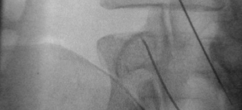 Radiofrequency Ablation
