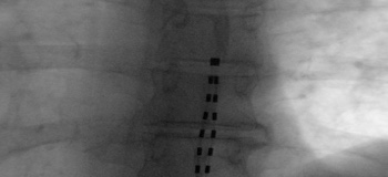 Spinal Cord Stimulator